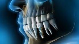 IMPLANTES